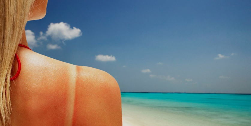 negative effects of sunburn